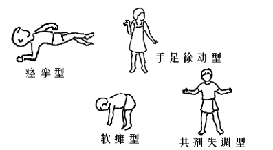 日常生活中预防小儿脑瘫发生的措施有什么